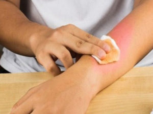 الحروق المنزلية وكيفية معالجتها والإسعافات الأولية